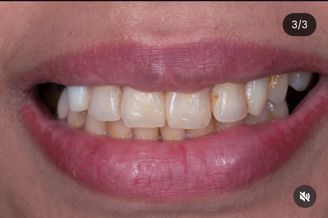 عدسات التجميلية (الفينير) — before