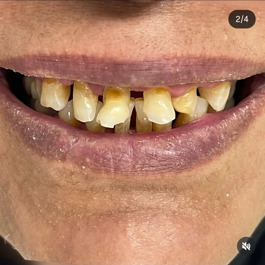إعادة تأهيل الفم الكامل — before