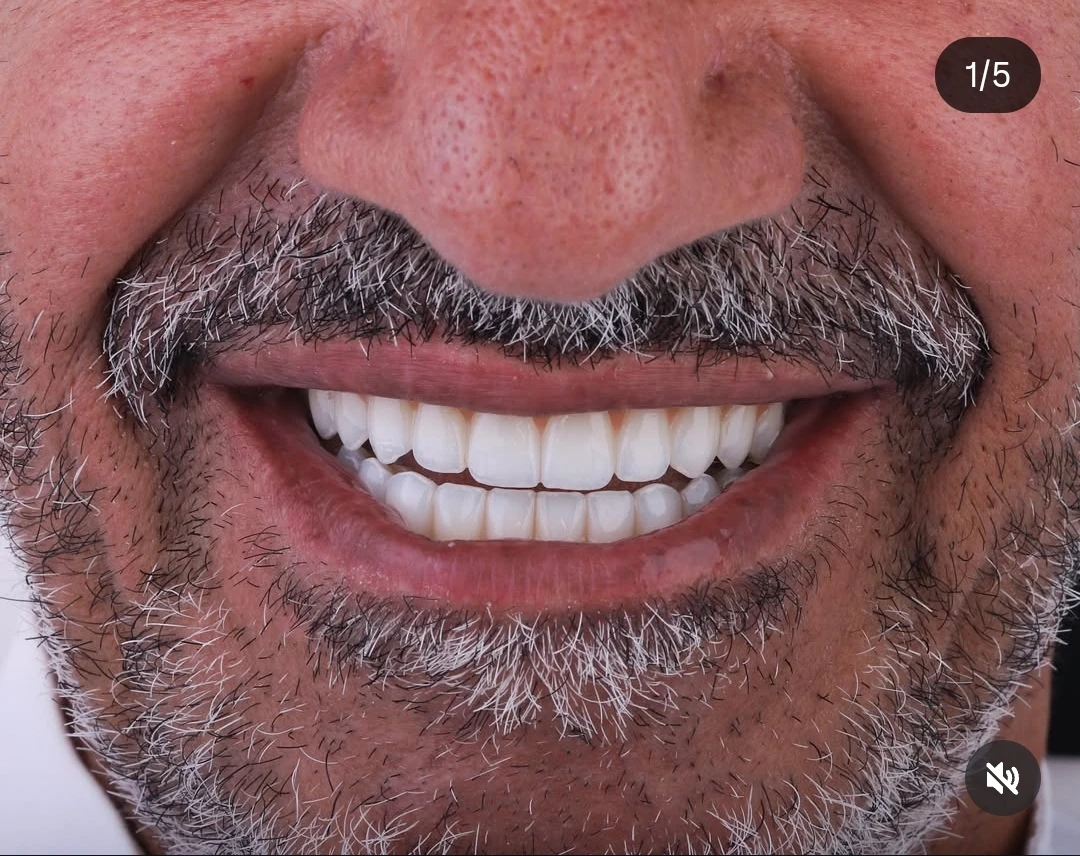 تعويضات ثابتة على الزرعات لكامل الفك — after